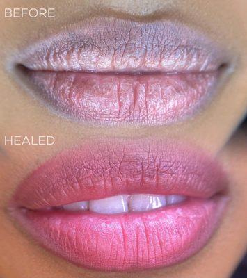 Dark Lip Neutralization Before and After