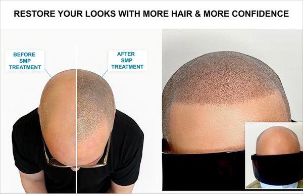 Scalp micro pigmentation is a solution for hair loss!