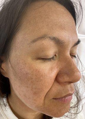 Before LaseMD treatment (hyperpigmentation &pigmentation)