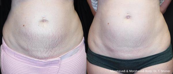 Before and After of Morpheus 8 TX. Morpheus 8 tightens skin while reducing stretch marks, etc.