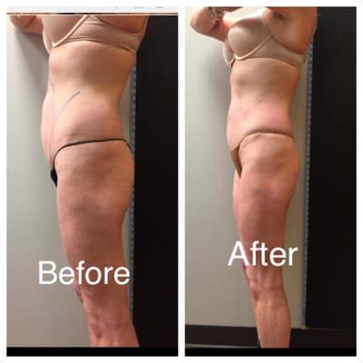 Ultratone Futura pro results after ONE treatment! Call TODAY and schedule your appointment! 410-583-0123 / Baltimorebodies@gmail.com