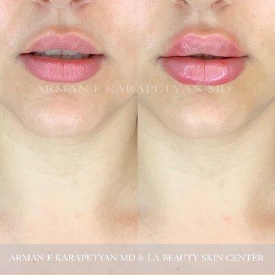 Non-surgical lip augmentation by Arman F Karapetyan, MD. How gorgeous!