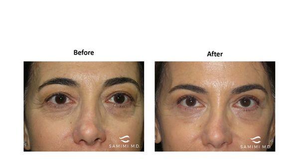 She had upper and lower blepharoplasty with Botox to help her achieve a better appearance.