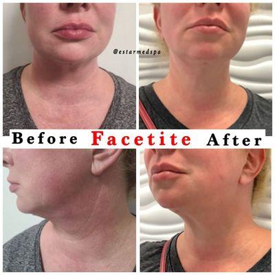 Facetite by Dr. Martins Before and After