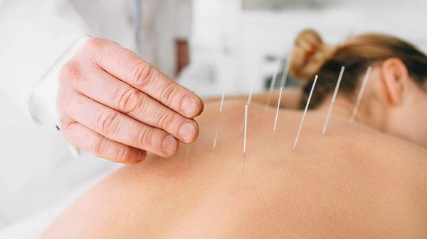 Chinese Acupuncture