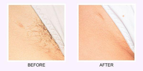 Laser hair removal