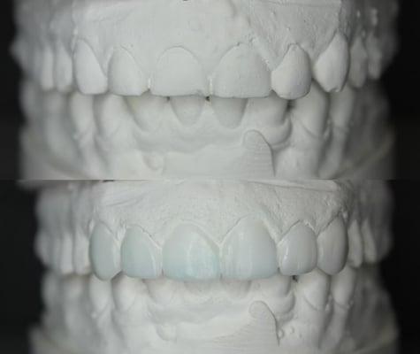 Full wax up prior to porcelain veneer fabrication.  It's a blue print for the patient and Dr. Lentz to review together.