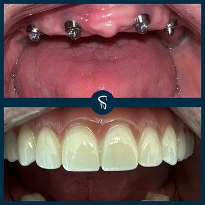 Before and After of Dental Implants