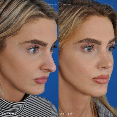 Rhinoplasty