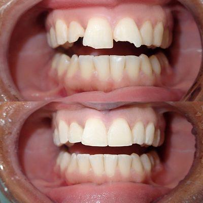 Before and after of teeth reconstruction