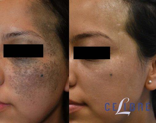 Cheek Birthmark removal before after