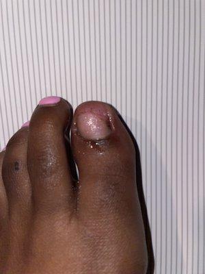 My broken, sore toe nail