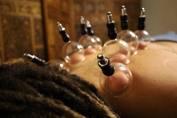 Glorious cupping therapy