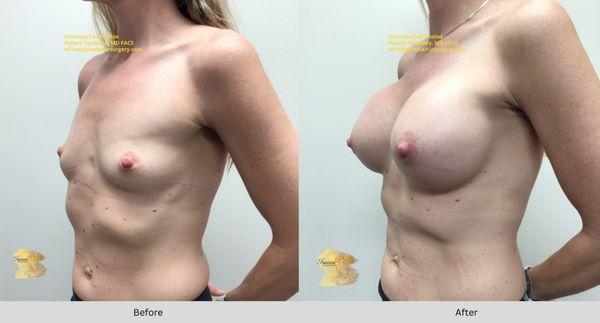 Breast Augmentation  Silicone Results 
This 41-year-old mother of two, standing at 5'4″ and weighing 115 lbs by Dr. Hardesty, Riverside Ca