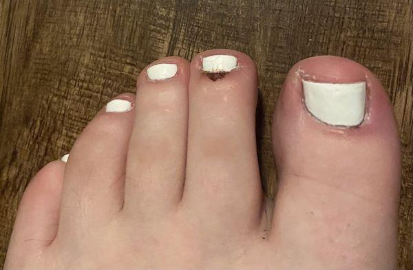 Results from the pedicure. Swollen big toe and bloody middle toe.