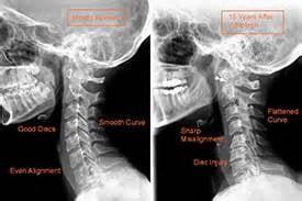 Normal cervical (neck) curve vs abnormal loss of curve.