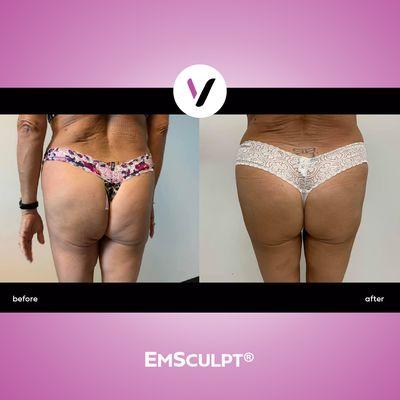 30 Min with EmSculpt equivalent to 20,000 squats! Tone your Bum.