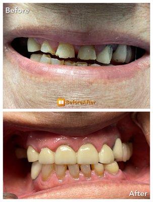 Severe clencher restored with beautiful zirconia work.