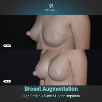 Breast Augmentation  450cc High Profile Silicone Implants