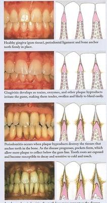 Periodontal Disease: The leading cause of tooth loss with a link to heart disease