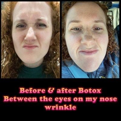 Before and after just 5 units of Botox on my nose crinkle. Excuse my silly face!