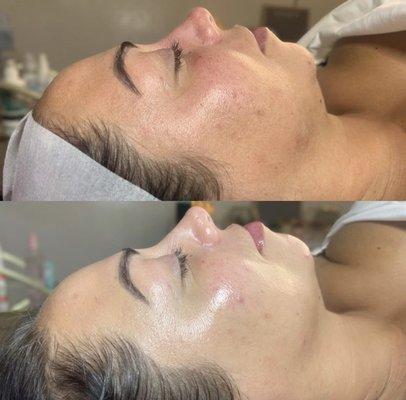 Dermaplaning Glass Facial