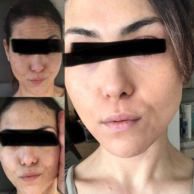 Microneedling