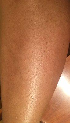 The left half of the lower leg is 3 weeks growth post IPL hair removal vs right side 3 weeks growth post shaving after 1 treatment.