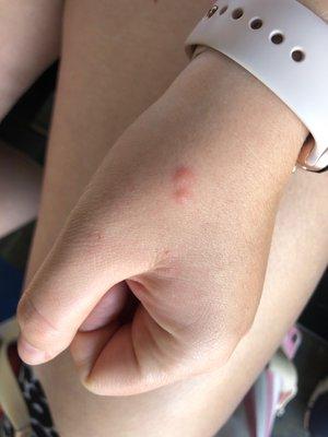 Mosquito/spider bites