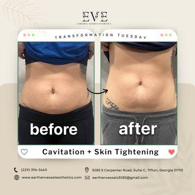 Cavitation + Skin Tightening