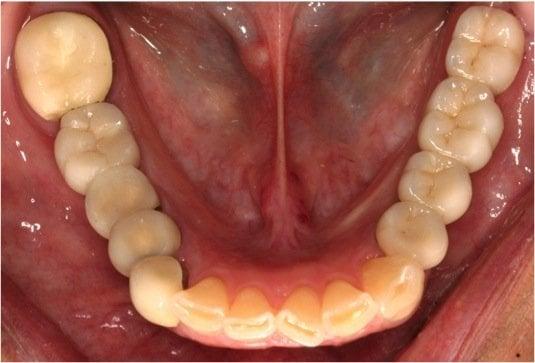 Posterior Implants After