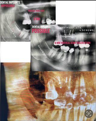 6 mm Vertical Bone Grafting Augmentation for dental implants.