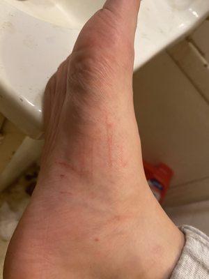 Cuts from mani pedi