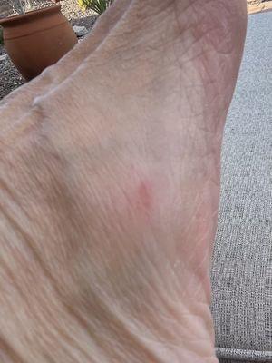 Side of right foot where callous remover tool cut my foot.