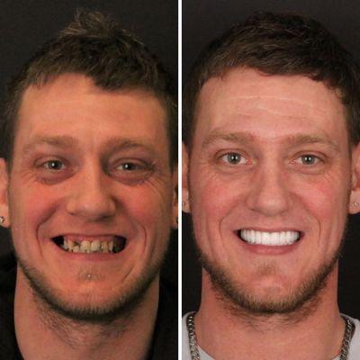 Final results from full mouth dental implants