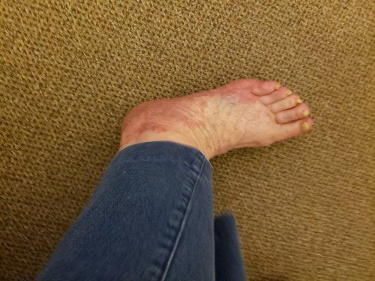 This is how my feet look now.  The cream is not clearing it up.  Please help, it itches and burns. It is getting worse.