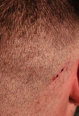 Cut on back of head