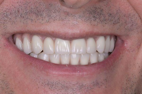 After. Upper and lower Full mouth reconstruction