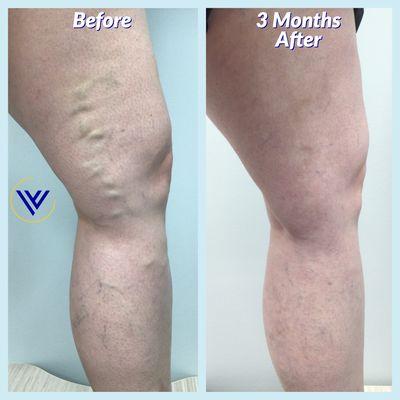 3 months after varicose vein treatment at Center for Varicose Veins - Dr. Vinay Madan