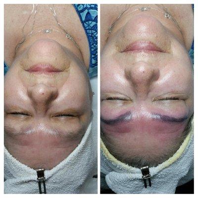 Microdermabrasion & O2 Infusion Therapy