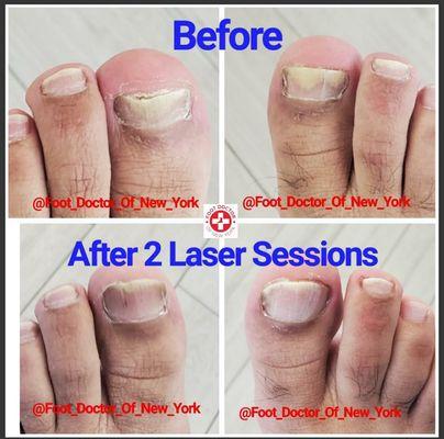 Laser Nail Therapy for Fungal Toenails..... Progress Pic.... Great results after only 2 sessions! www.FootDocNY.com/LaserNail