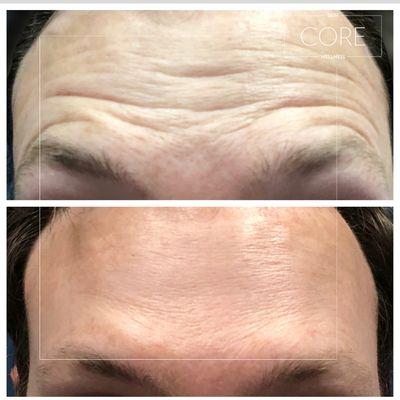 Botox can help help decrease the appearance of fine lines and wrinkles. The bottom photo is two weeks after treatment.