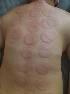 Cupping therapy