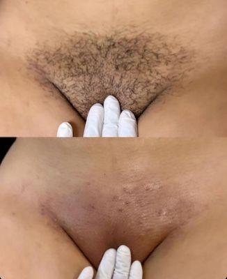 Before and after Brazilian Wax