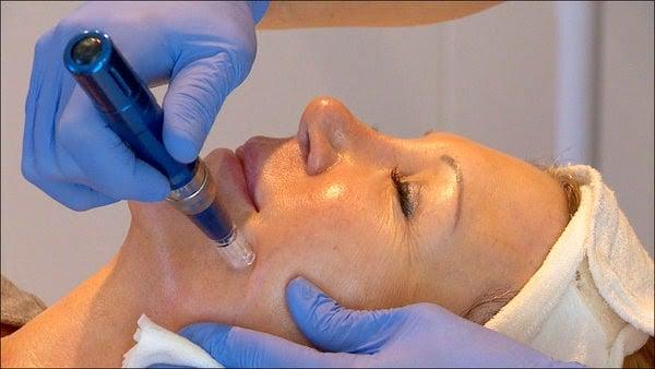 The SkinPen creates microscopic channels to boost collagen and fight fine lines and wrinkles without downtime. (WFAA 8)