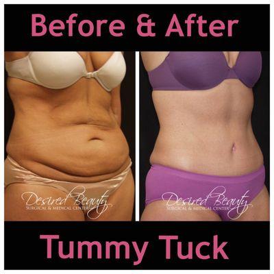 Tummy Tuck Before & After