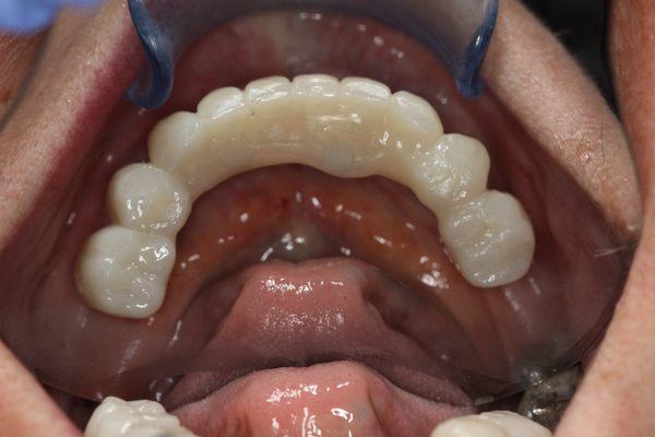 A new set of implant retained teeth are places and the patient can eat and smile comfortably for the first time in years.