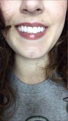 My teeth looked GORGEOUS after my cleaning and whitening session - just ONE session. Don't even need a filter on the photo.