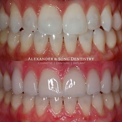 Six units of natural and beautiful porcelain veneers