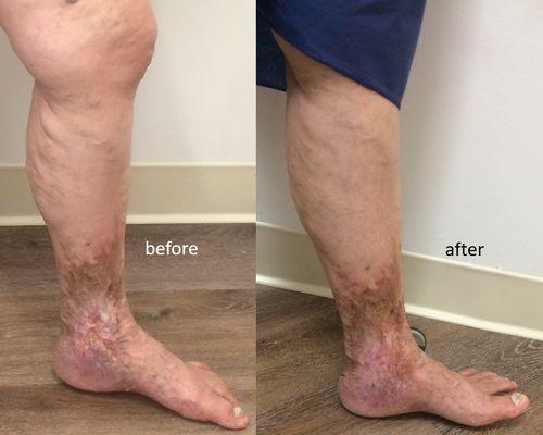 venous ulcer treatment, venous stasis treatment